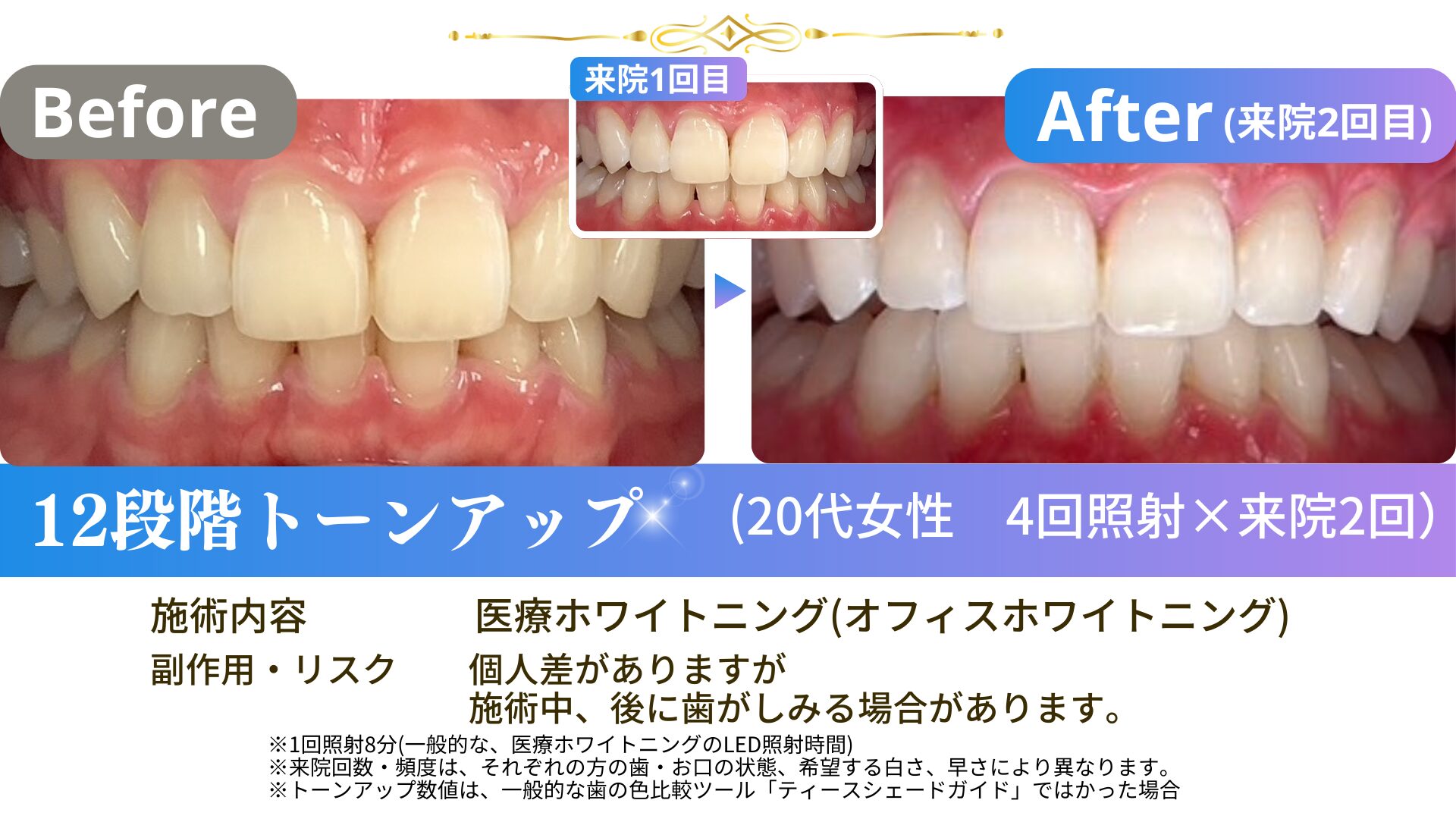 240928-20代女性スタンダード4回照射×2-20fs4×2-02