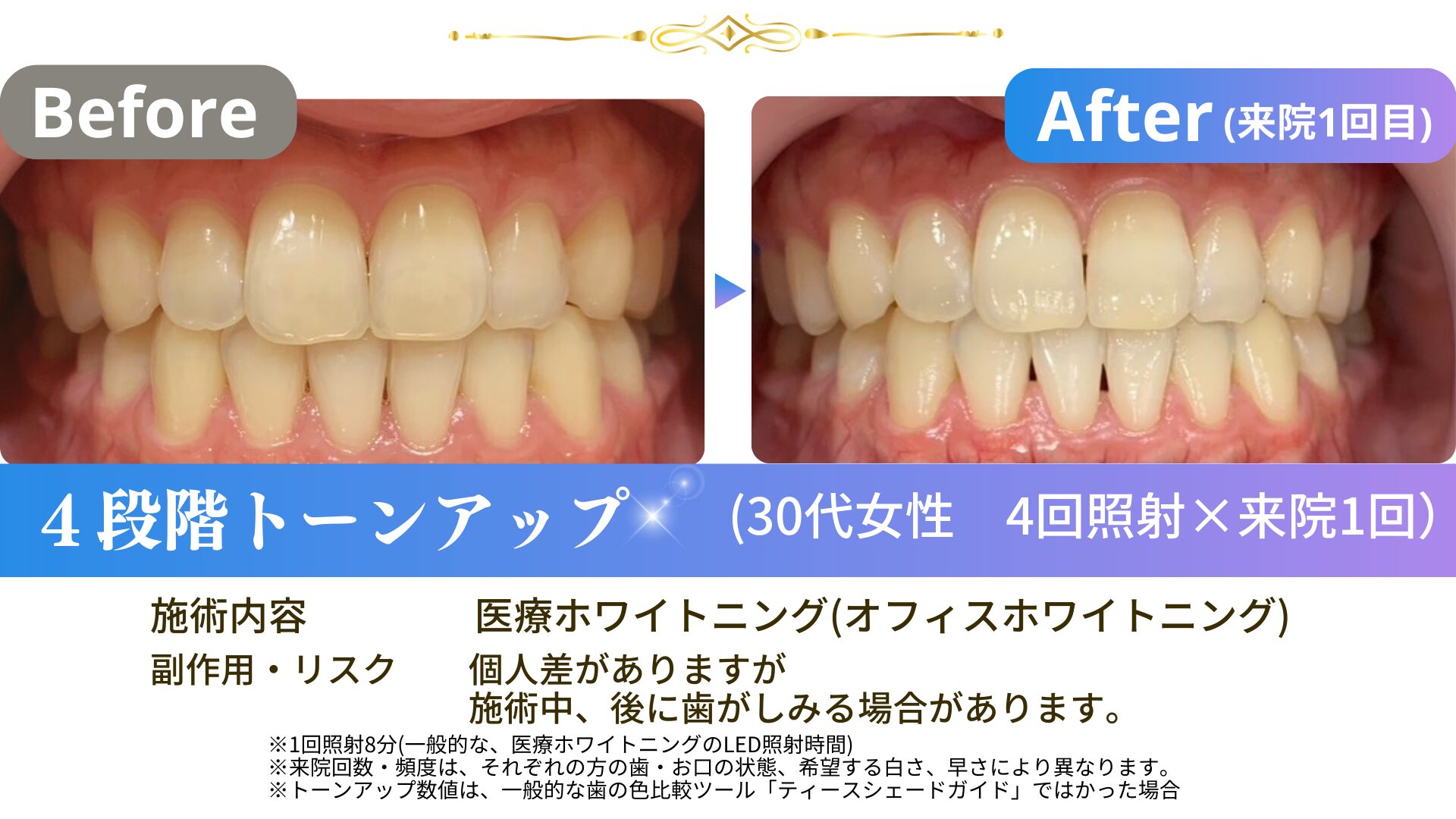 240928-30代女性スタンダード4回照射×1-30fs4×1-02