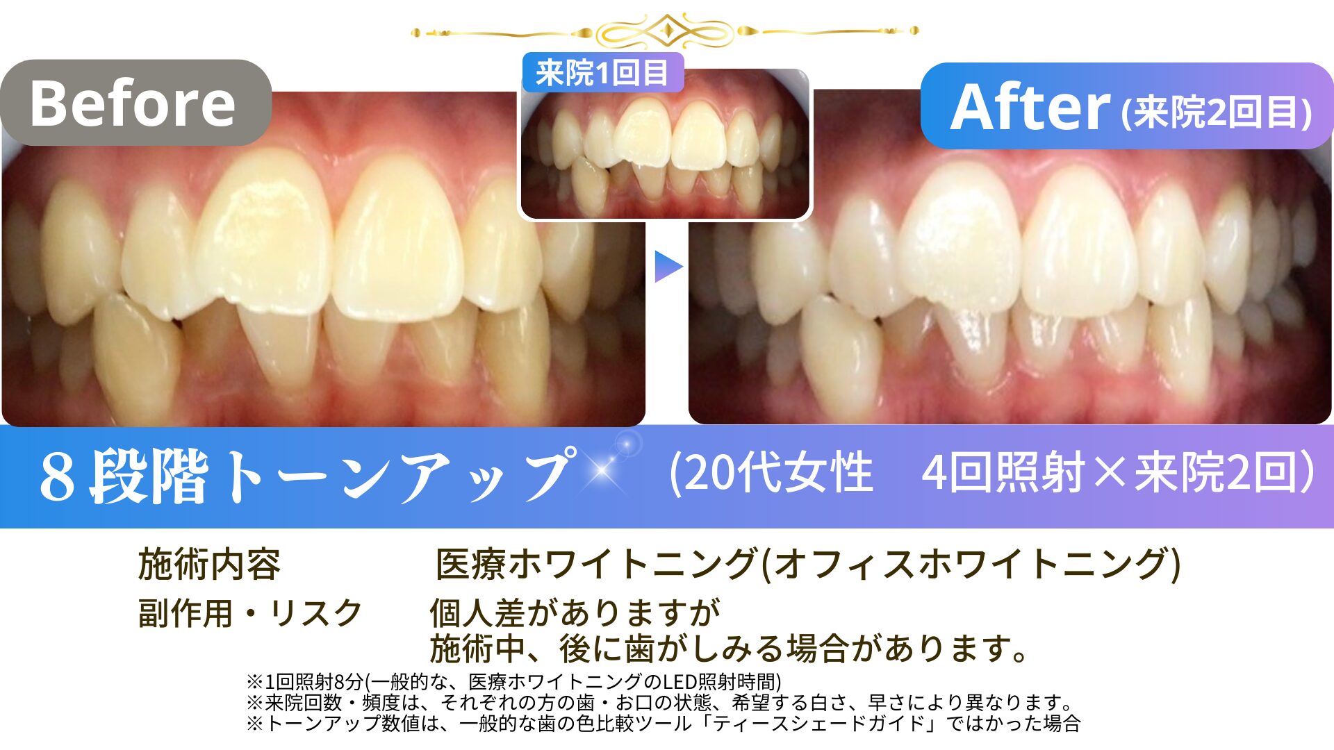 250115-25歳女性スタンダード4回照射×2-25fs4×2-02