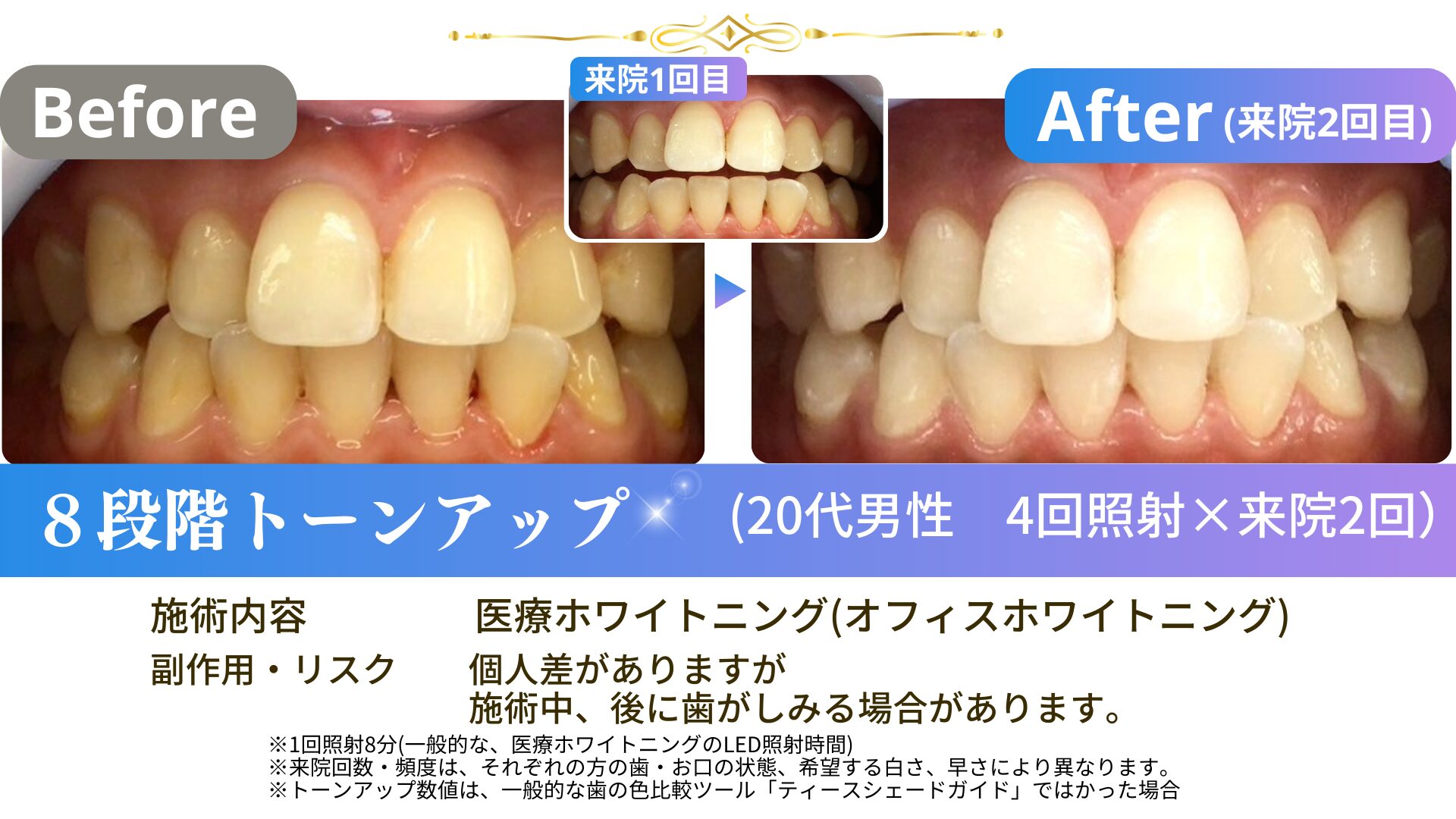 250115-29歳男性スタンダード4回照射×2-29ms4×2-02
