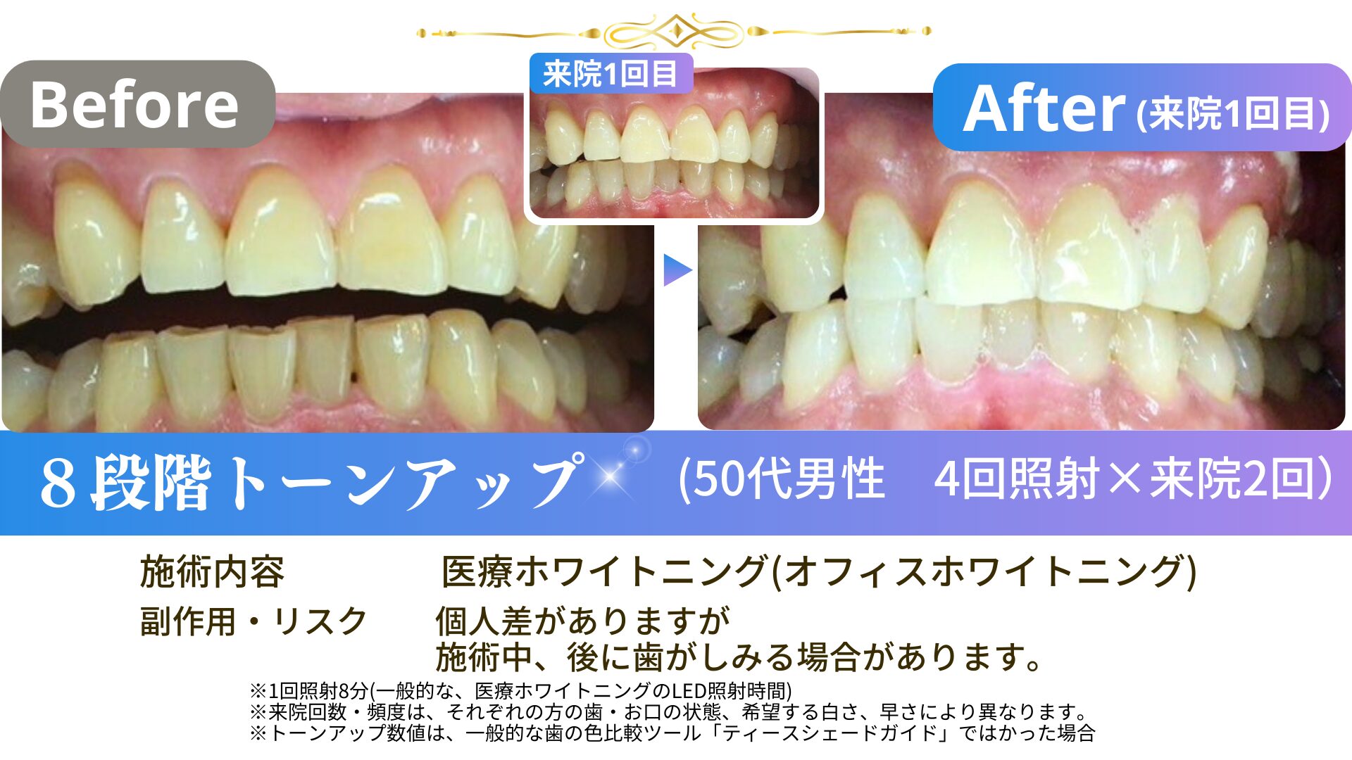 250115-55歳男性スタンダード4回照射×2-55ms4×2-02