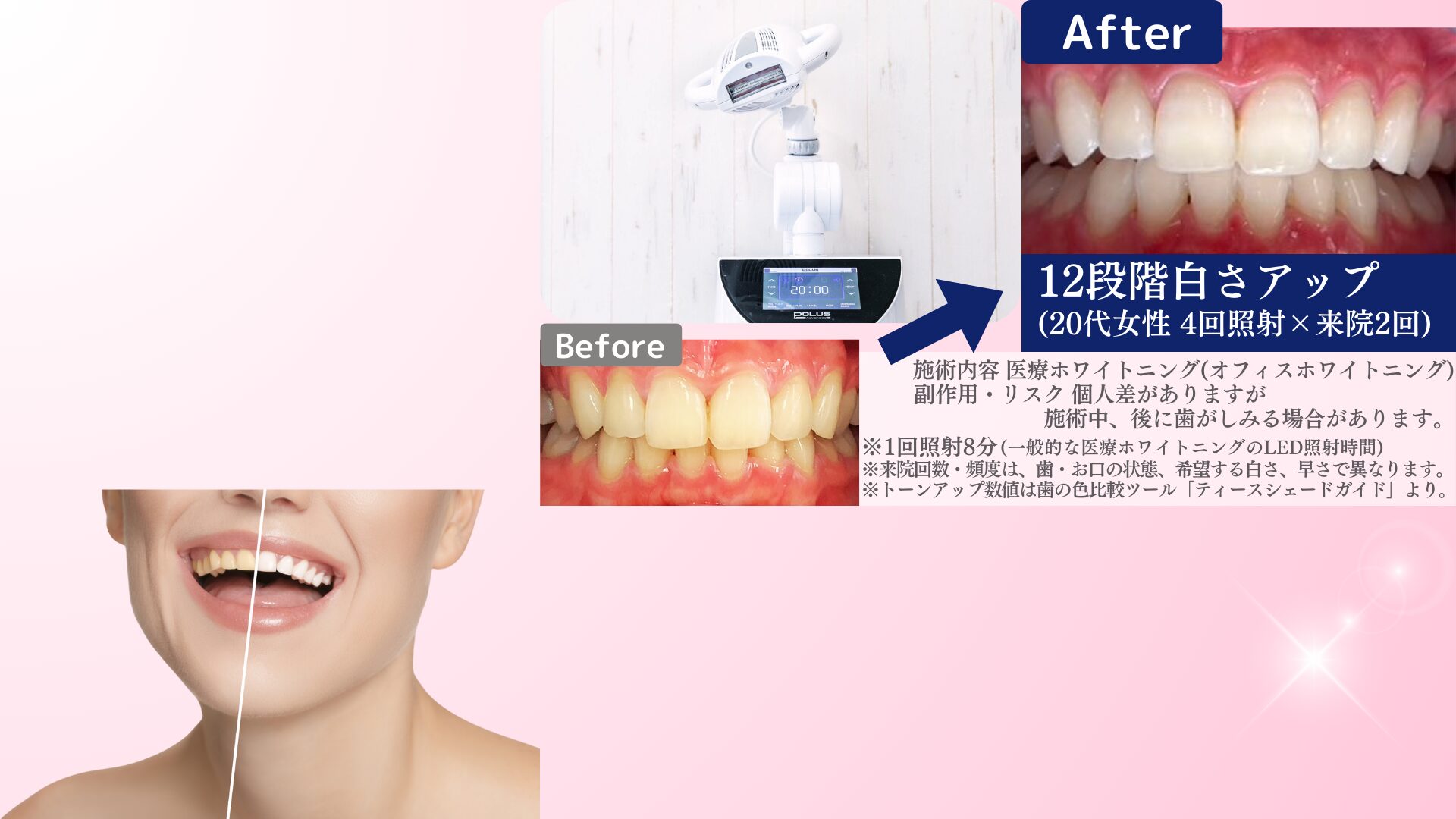 ホワイトニングで歯は傷つかない!痛みの原因と安全性を徹底解説