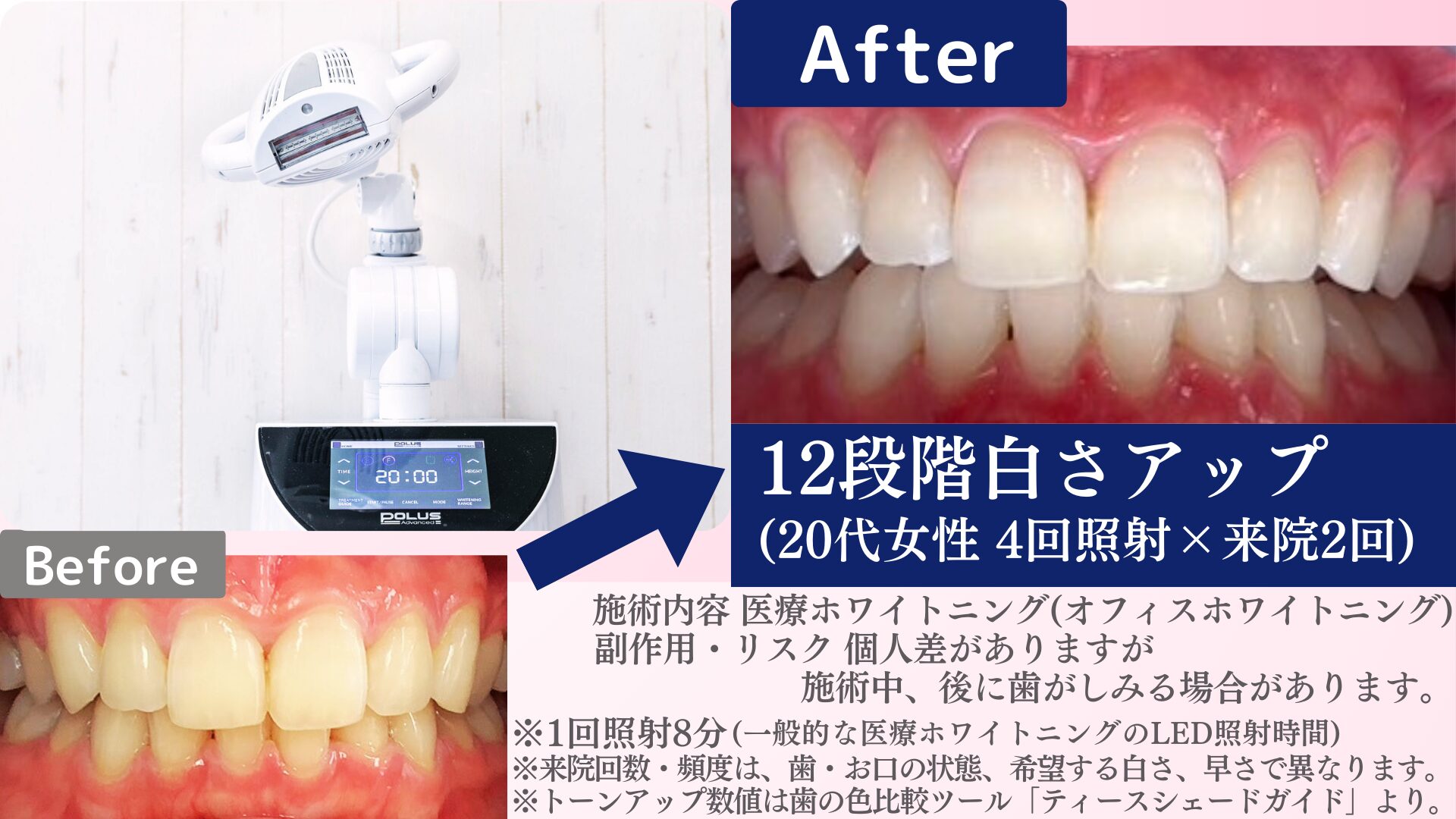 ホワイトニングだけで大丈夫?クリーニングが重要な理由と相乗効果