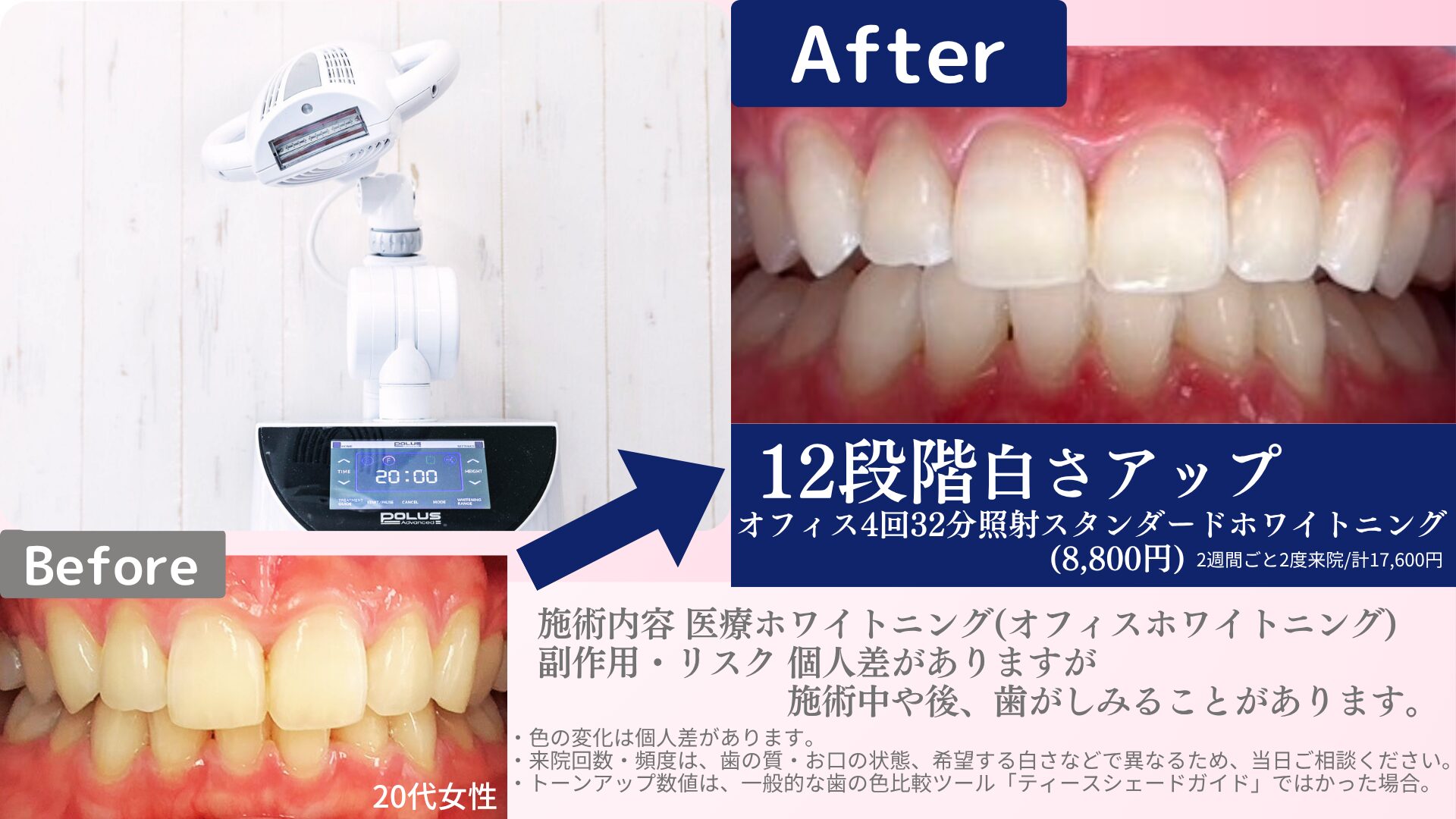 オフィスホワイトニングの「回数」とは?塗り直し・通院回数との違いを歯科医師が解説